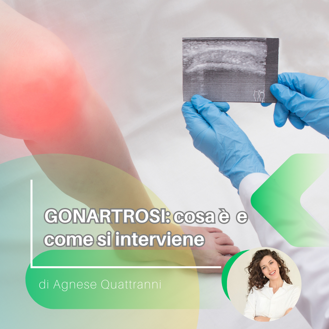 GONARTROSI: cosa è e come si interviene